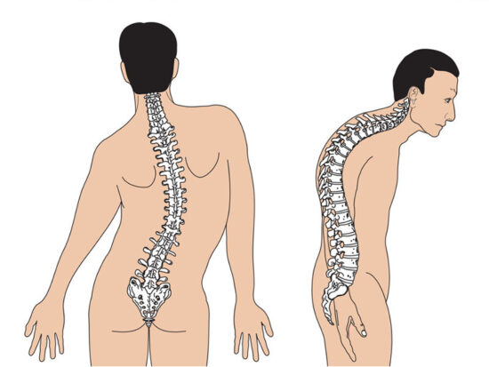 Cong-vẹo-cột-sống Cong-vẹo-cột-sống