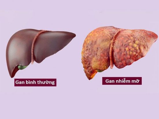 Gan-nhiễm-mỡ Gan-nhiễm-mỡ